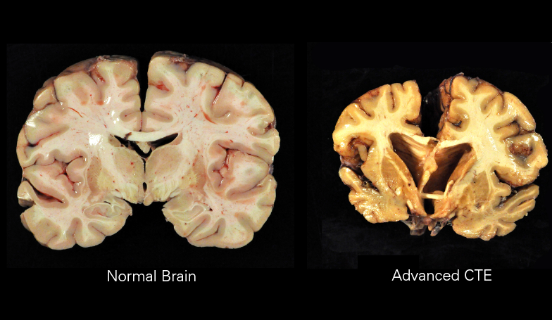 The image portrays the effects that CTE has on the brain and compares it to a normal brain, showing the damage done to NFL players. (Image courtesy of Boston University)