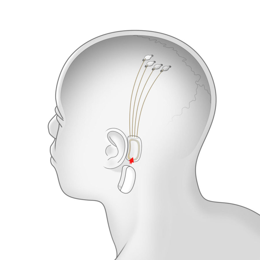 A+rough+design+of+the+external+implant%0ACourtesy+of+Businessinsider.com